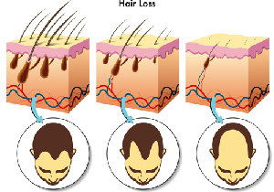 AGA治療はコスパが重要～薄毛の悩みを抱える人は1200万人　の画像1
