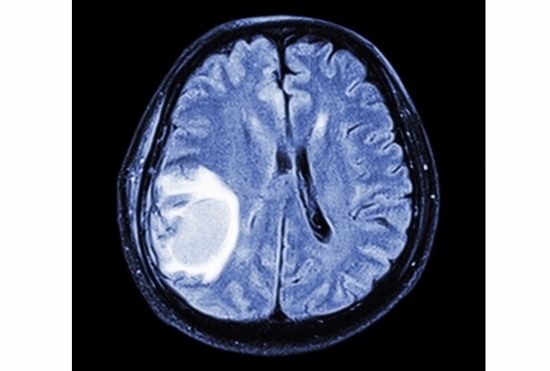 ケータイ電波、脳腫瘍の原因との報告も…最悪なら致死率95％、レントゲン検査が原因かの画像1
