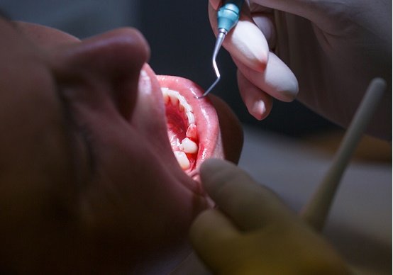 歯が抜け落ちる…歯周炎、「歯磨きで防げる」のまやかし、新事実浮上の画像1