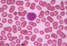 不要ながん治療が患者を殺す？がん診断の9割は間違い？治療やめたら治る例も