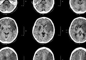 コレステロールや塩摂取制限は人体に危険！肉などの動物性脂肪は健康に良い！