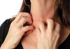 蚊やブヨの虫刺され、ナメると危険！掻くのは絶対NG！皮膚炎が全身に広がり治療困難も