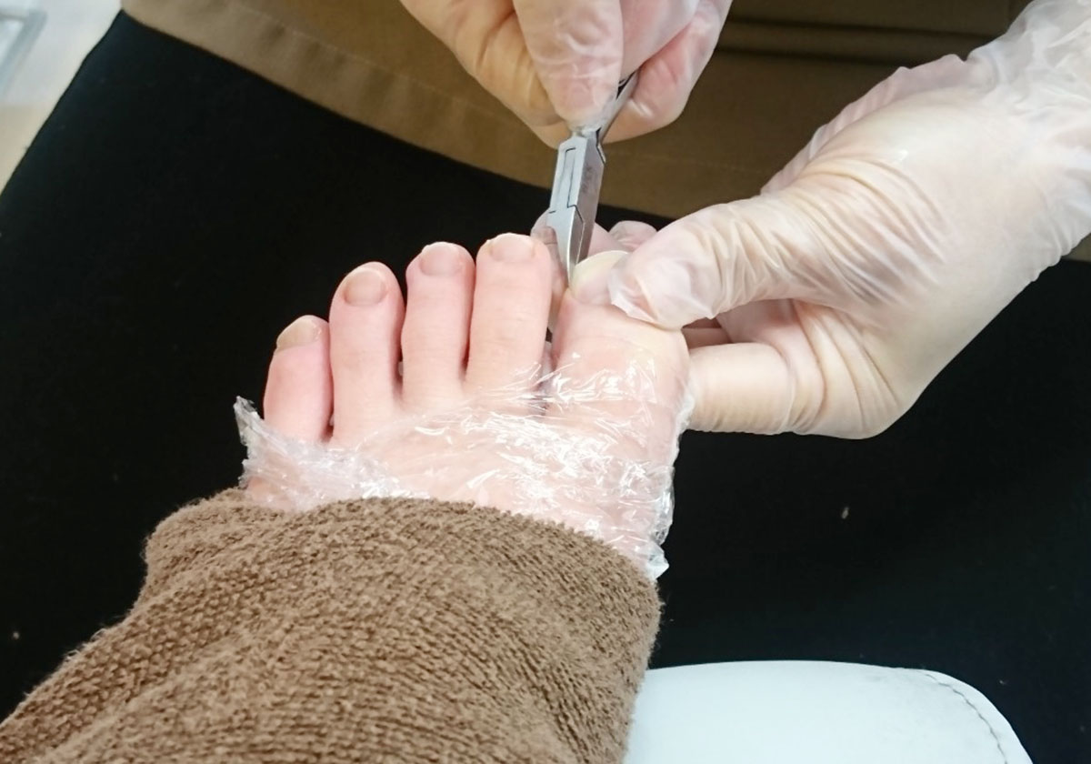 間違った 足の爪の切り方 はこんなに危険 深爪 陥入爪 腰や膝の故障などの原因に